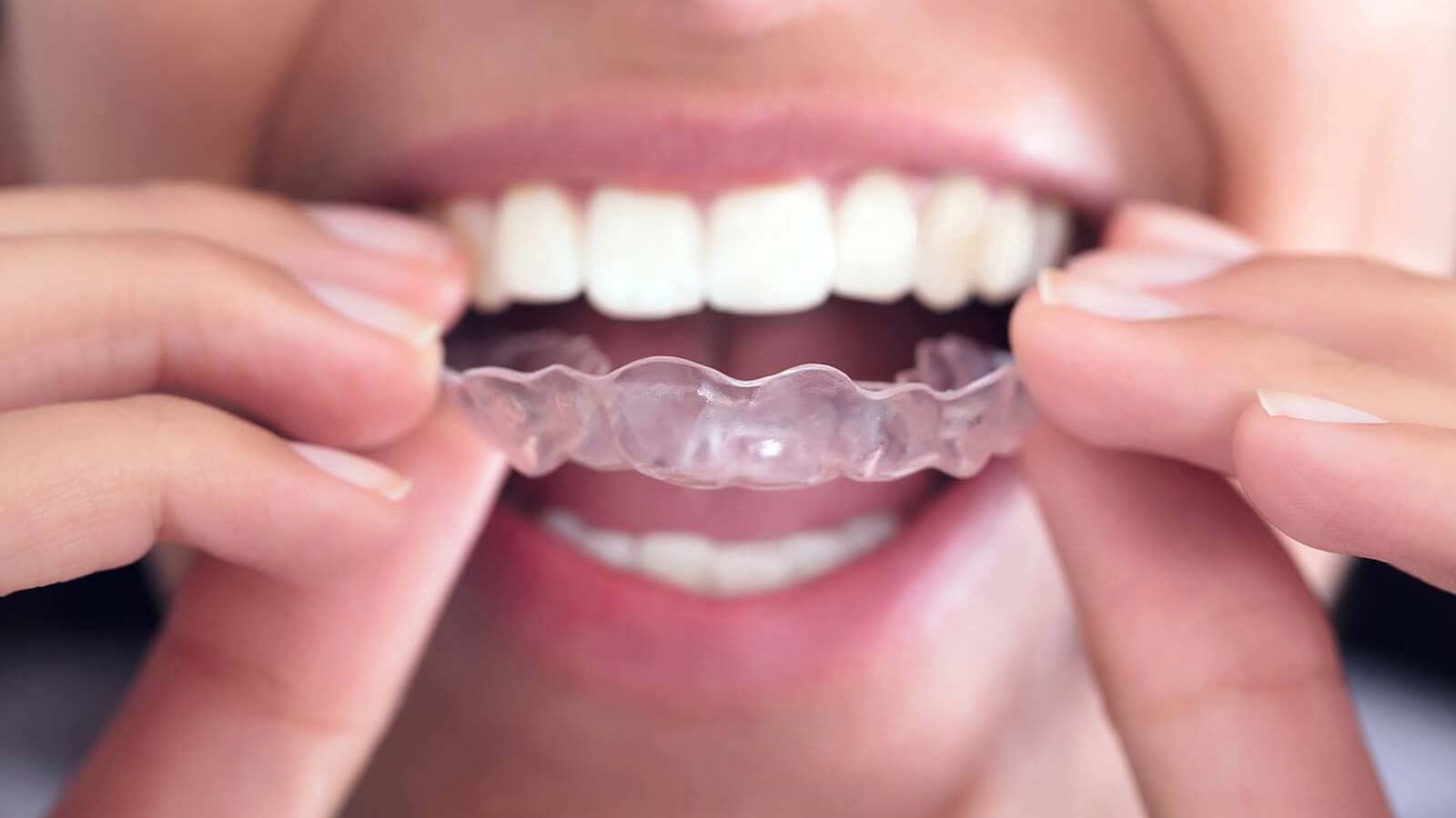 How Invisalign Has Changed Orthodontic Office Design